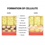 Συσκευή κατά της κυτταρίτιδας με αναρρόφηση Celluless MD - 7